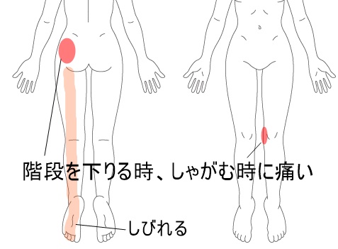 膝の痛み 変形性膝関節症 の症例 鍼灸 はりきゅう 室 楽 静岡県浜松市中区寺島町