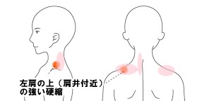 肩こり症例②