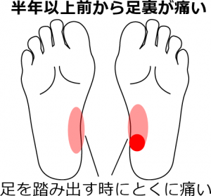 足の裏の痛み 足底筋膜炎 の症例 鍼灸 はりきゅう 室 楽 静岡県浜松市中区寺島町