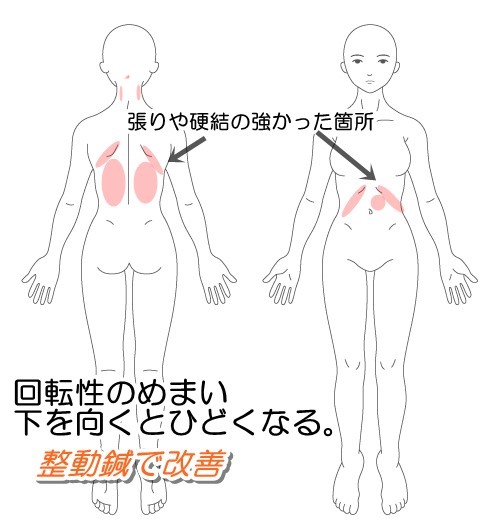 回転性めまい