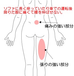 急性腰痛