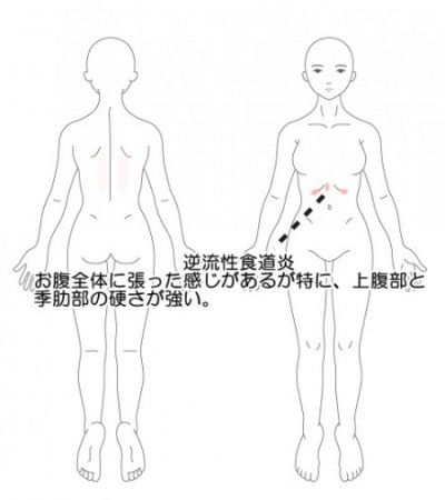 逆流 性 食道 炎 症状 背中 の 痛み