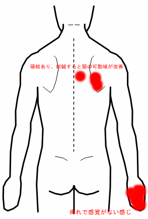 首 から 肩 にかけて の 痛み